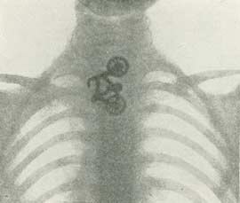 Røntgen billede med en slugt legetøjscykel.