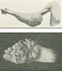 Billeder af kræftsvulster i fod og arm.
