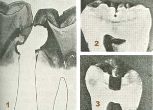 Kindtænder under angreb af karies.