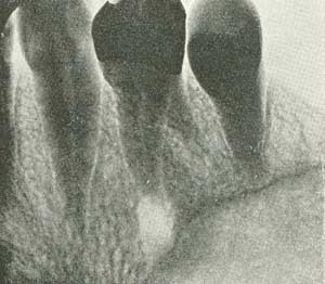 Kronisk betændelse i tænderne.