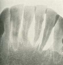 Slutstadiet af af Pyorrhea alveolaris