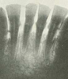 Begynderstadiet af Pyorrhea alveolaris.